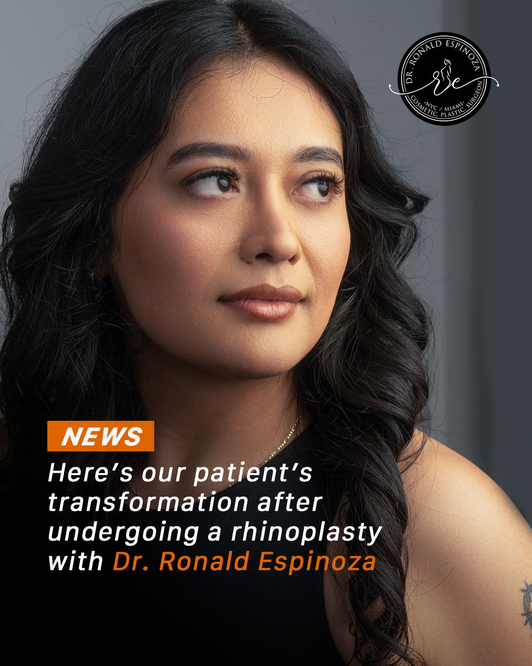 Patient portrait after rhinoplasty with Dr. Ronald Espinoza