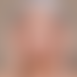 natural facelift result by Dr. Ronald Espinoza Cosmetic Plastic Surgery