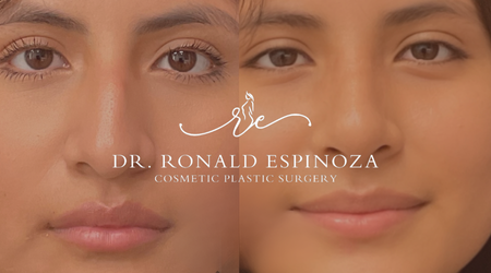 Top 10 Rhinoplasty Myths—And the Truth Behind Them