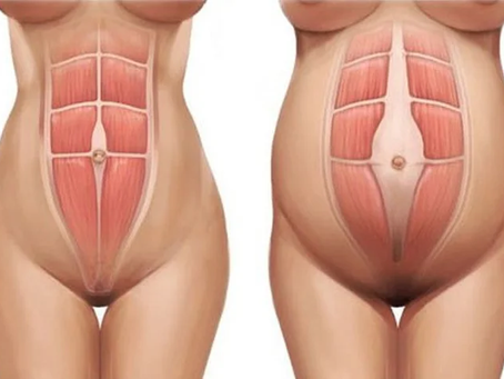 abdomem com diástase