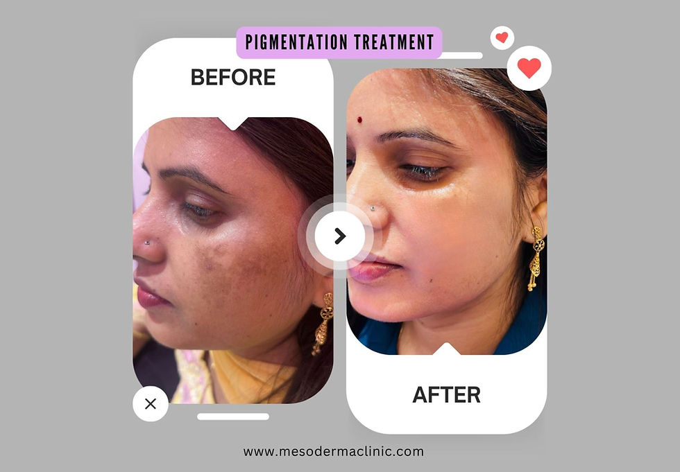 PIGMENTATION TREATMENT 1