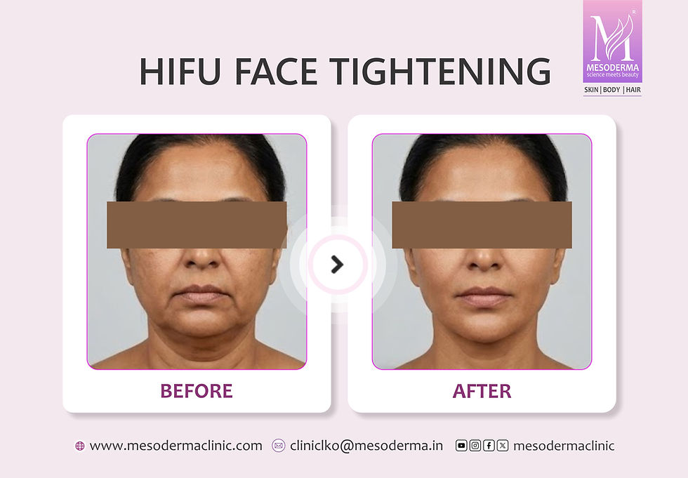 HIFU FACE TIGHTENING