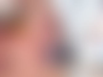 The Myth of Microneedling: Does a Deeper Needle Mean Better Results for Pigmentation?