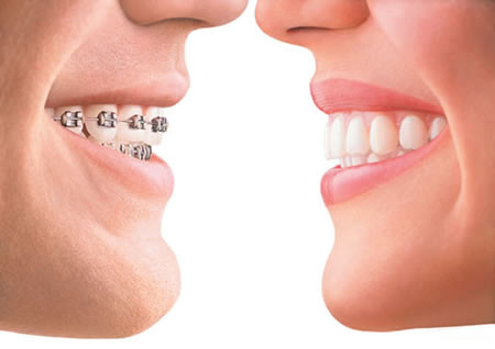 aparelho dental invisivel