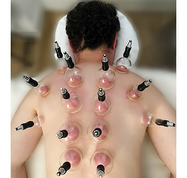 Cupping Therapy