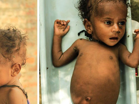 Acute Malnutrition More Than A Third-World Problem