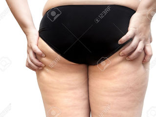Coolsculpting congela la grasa localizada...por solo c60.000