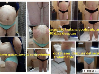 Perder la grasa localizada con Coolsculpting