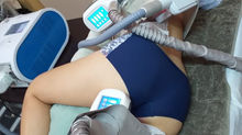 CRIOLIPOLISIS muslos y espalda