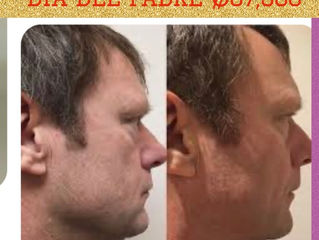 Solo para hombres 25% descuento en Hifu Facial rejuvenece hasta 10 años sin bisturí. Ahora ₡67,500