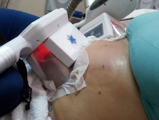 CRIOLIPOLISIS  es un tratamiento seguro para #eliminarlagrasacorlocalizada congelandola a -10 bajo 0