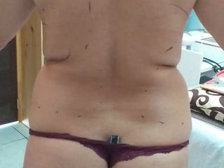 CRIOLIPOLISIS 1 sesion c45.000