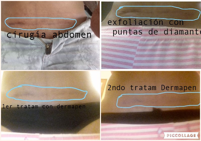 Eliminar cicatrices con Dermapen