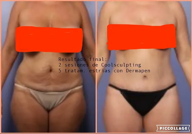 Quitar la del estrias abdomen como y flacidez
