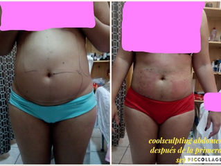 New Coolsculpting Zeltiq 4 cabezales