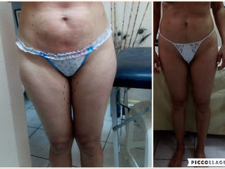 Coolsculpting realidad sin riesgos!