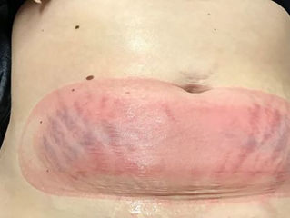 CoolSculpting 40% descuento y obsequio rejuvenecimiento de codos con microdermoabrasion con puntas d