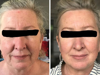 HIFU 7D LIFTING FACIAL Y TENSADO CORPORAL DURADEROS