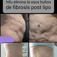 Criolipolisis Zeltiq* precio promocional del paquete 4 horas en dos sesiones de CRIOLIPOLISIS