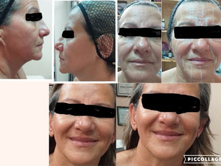 hifu costarica El lifting facial sin cirugia!