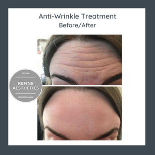 Anti-Wrinkle (1).png