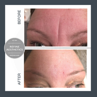BeforeAfter - Botox 2.png