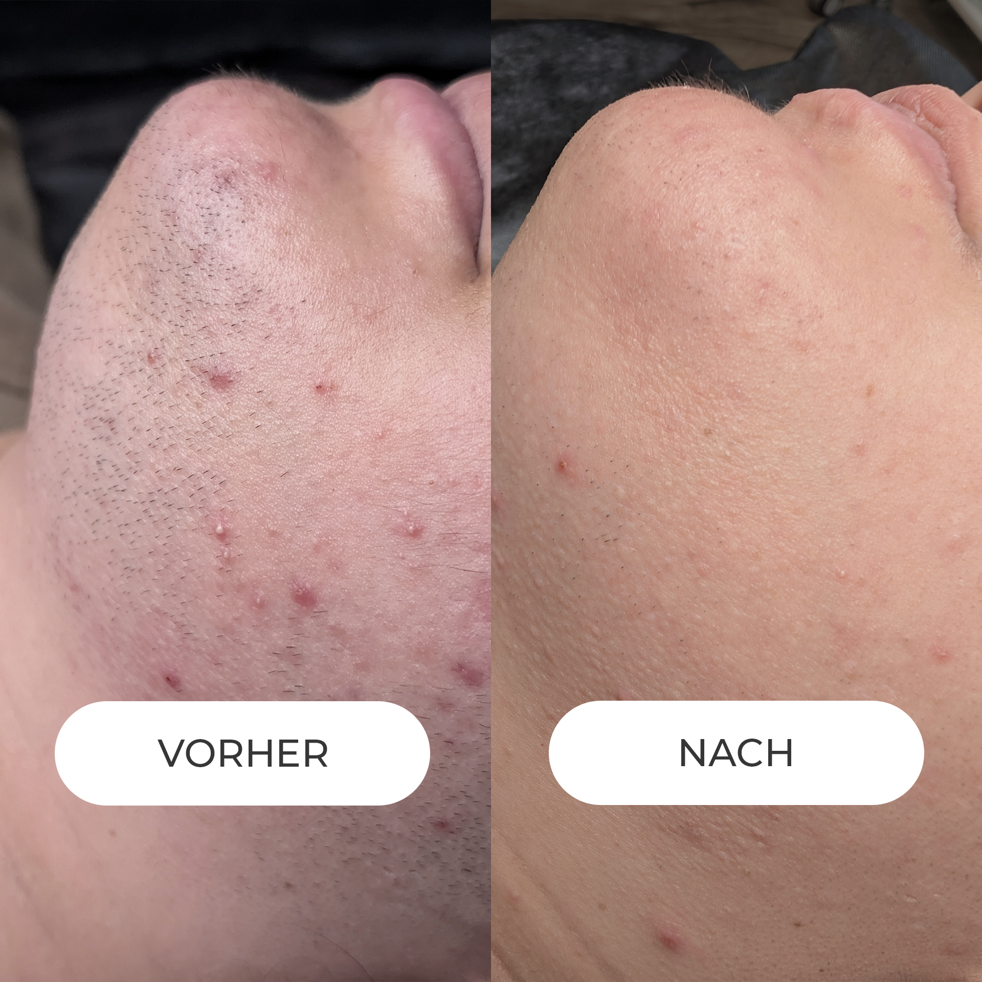 DAUERHAFTE HAARENTFERNUNG mit modernster Lasertechnologie in Rosenheim. 