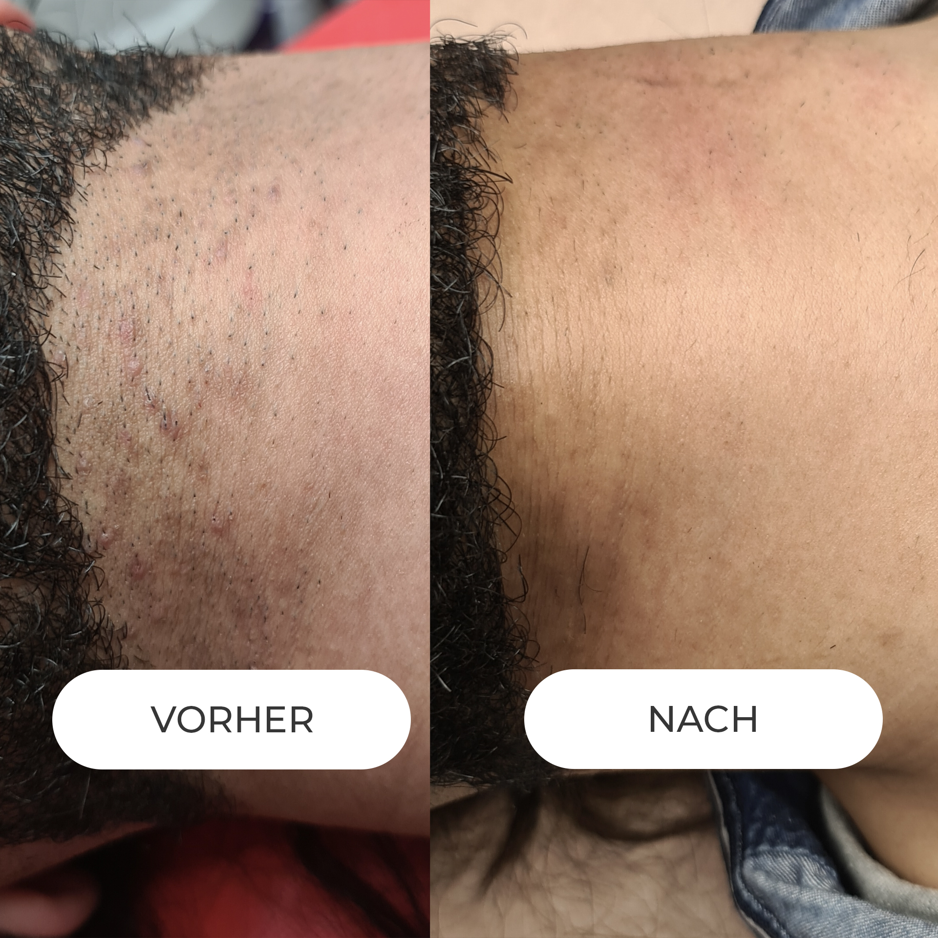 DAUERHAFTE HAARENTFERNUNG mit modernster Lasertechnologie in Rosenheim. 