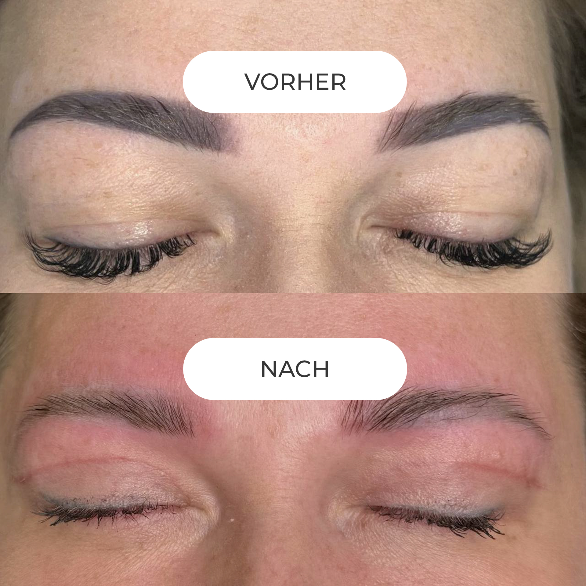 PERMANENT MAKE-UP ENTFERNUNG Sofern Ihr Permanent Make-up nicht länger Ihren ästhetischen Ansprüchen genügt