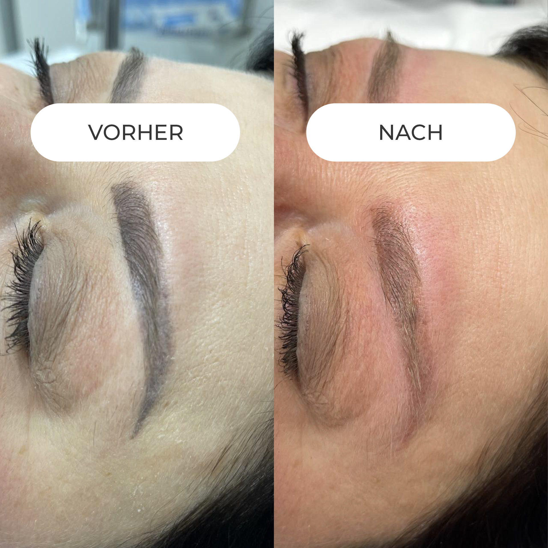 PERMANENT MAKE-UP ENTFERNUNG Sofern Ihr Permanent Make-up nicht länger Ihren ästhetischen Ansprüchen genügt