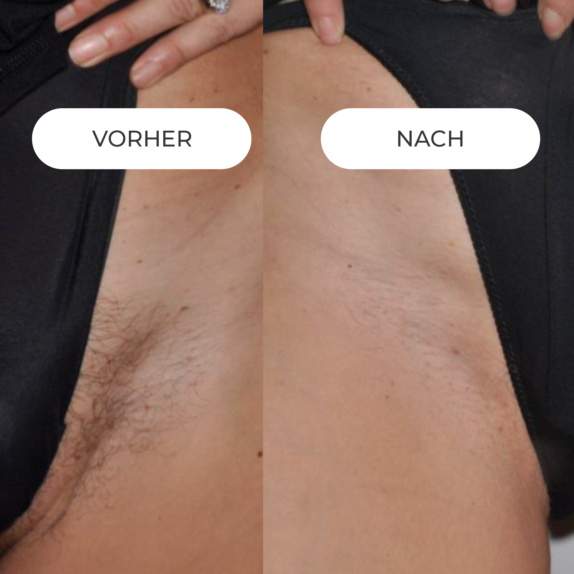 DAUERHAFTE HAARENTFERNUNG mit modernster Lasertechnologie in Rosenheim. 