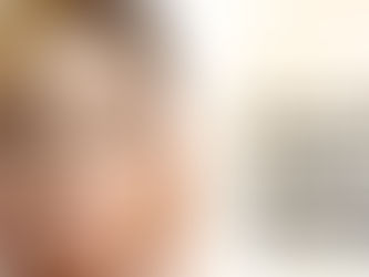 [ รีวิวศัลยกรรม ] ลดขนาดหน้าผาก สิ่งที่ทำให้สาวๆขาดความมั่นใจที่สุดค่ะ