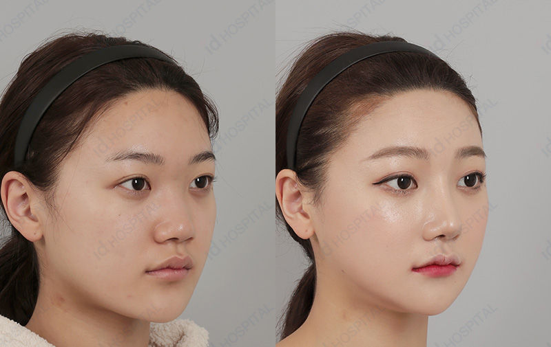 Before & After