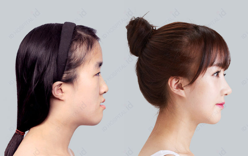 Before & After