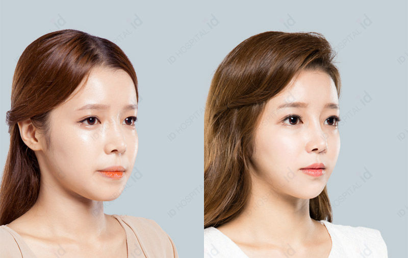 Before & After