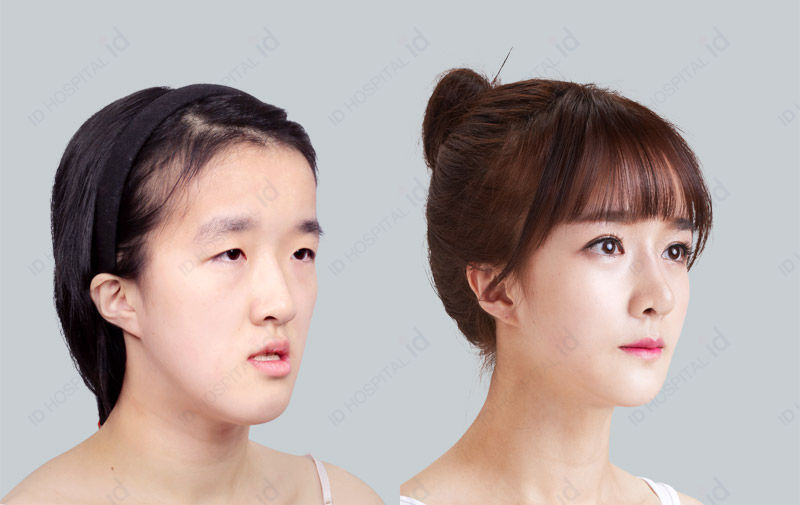 Before & After