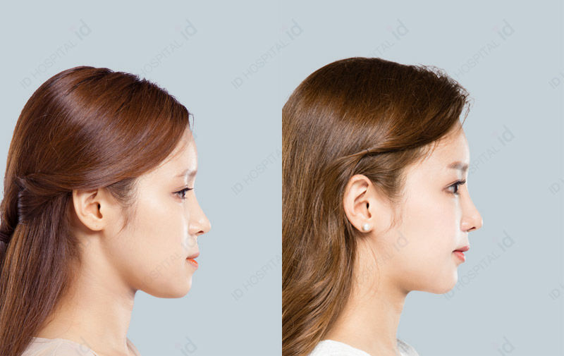 Before & After