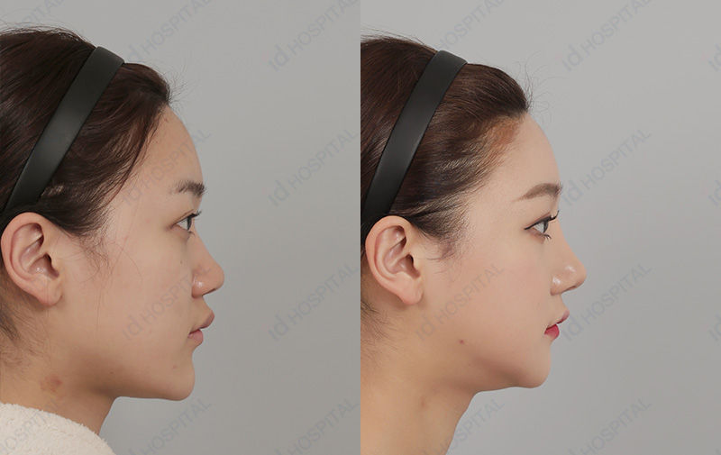 Before & After