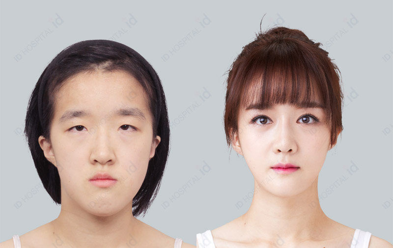 Before & After