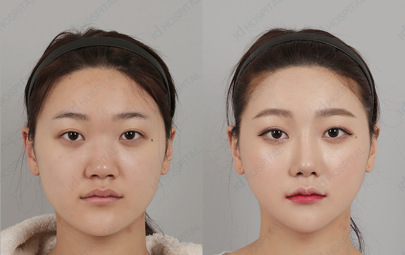 Before & After