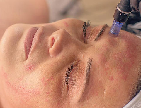 Close up photo of microneedling-treatment Der Profi, Ballina