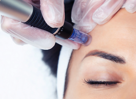 Microneedling facial at Der Profi, Ballina