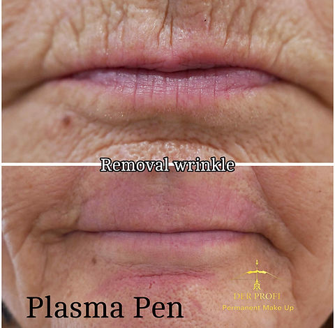 Before and after wrinkle reduction with plasma pen