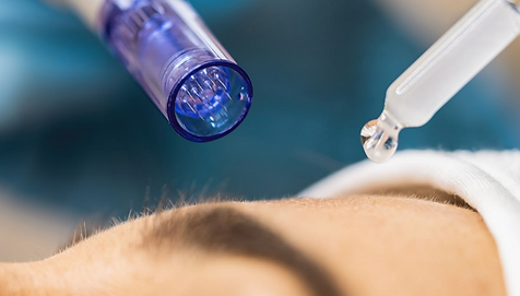 Close up of Microneedling Facial infused with Collagen facial, Der Profi, Ballina