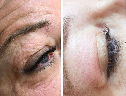 Close up photo of client eyelids using Plasma pen, before and after , Der Profi, Ballina