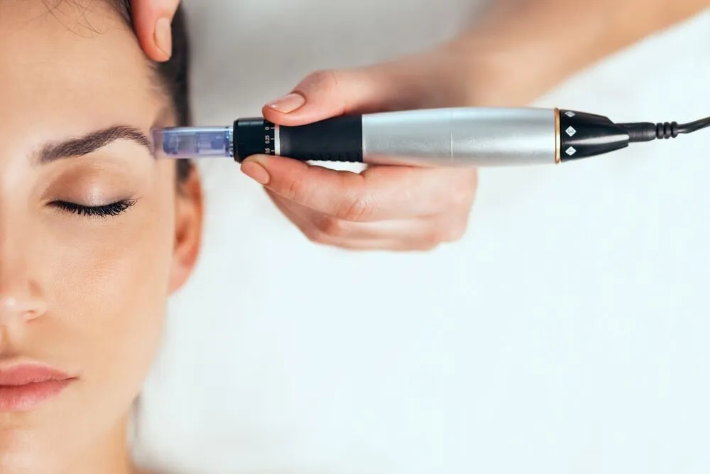 Microneedling treatment