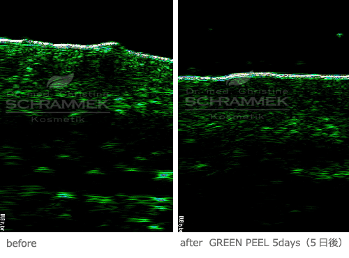 グリーンピール皮膚効果・角質層
