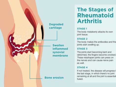 A Recap of Rheumatoid Arthritis