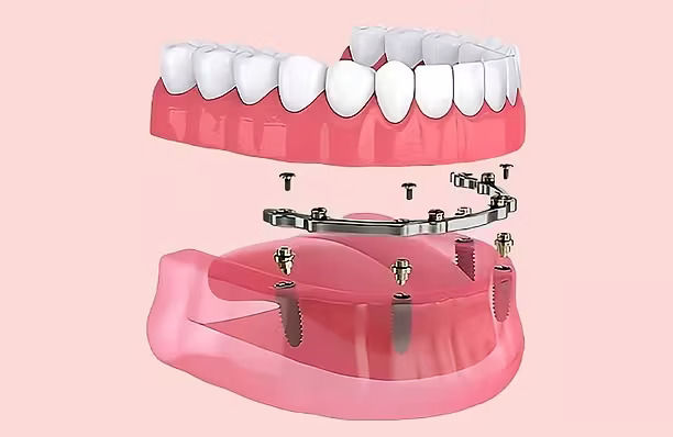 eka-implant-supported-dentures.jpg