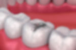 Tooth filling.jpg